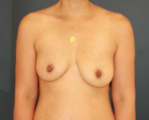 Feel Beautiful - Breast Asymmetry 105 - Before Photo